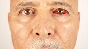 Bahaya Diabetes pada Mata: Mengenal Risiko Perdarahan dan Kebutaan